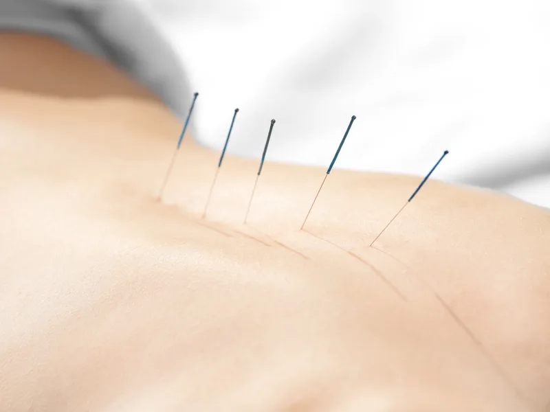 Acupuncture at Mountain Creek Chiropractic in Red Bank