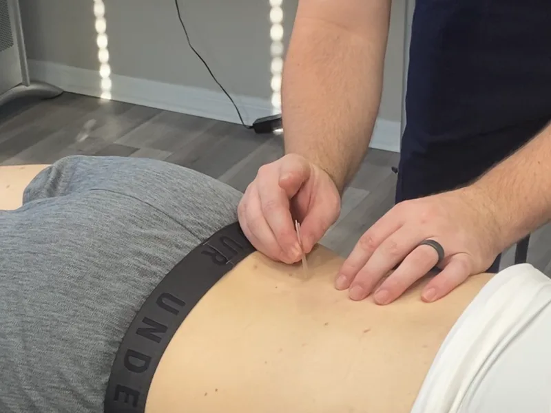 How Dry Needling works at Mountain Creek Chiropractic