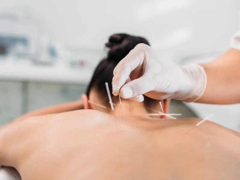Dry Needling at Mountain Creek Chiropractic in Red Bank
